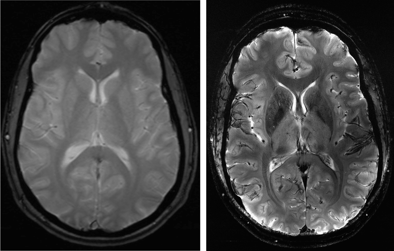 T2* weighted image of the brain at 1.5T (left) and 7T (right)